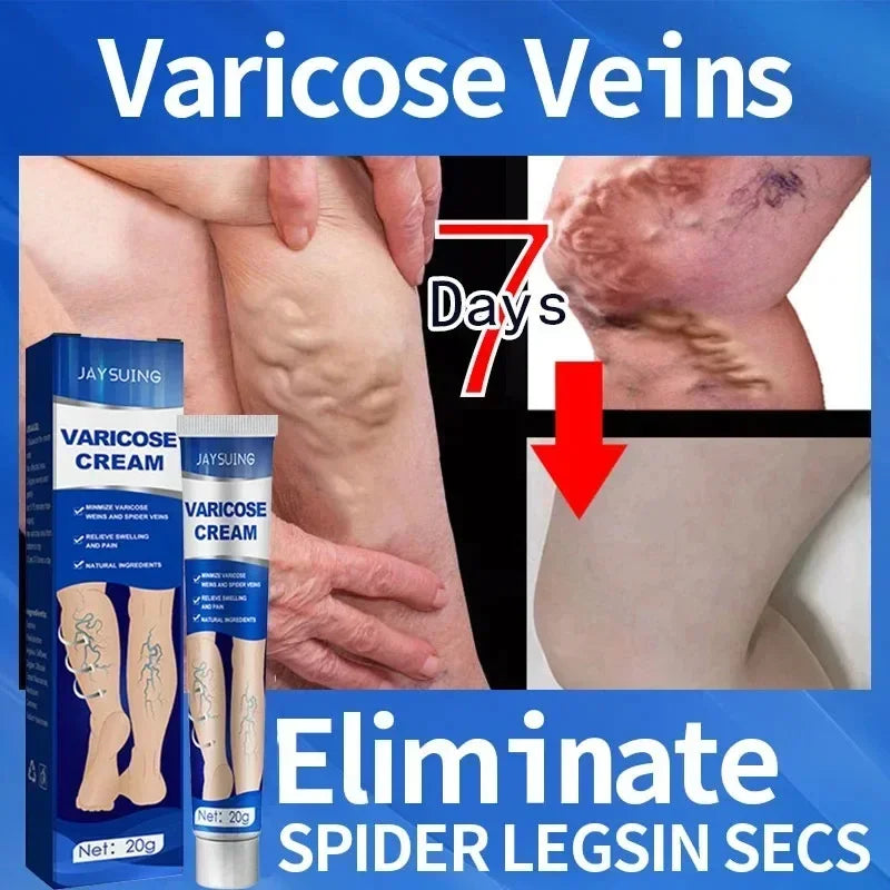 Ointment for Varicose Veins Eliminate Vasculitis Phlebitis to Relieve Spider Leg Pain Treatment Herbal cream
