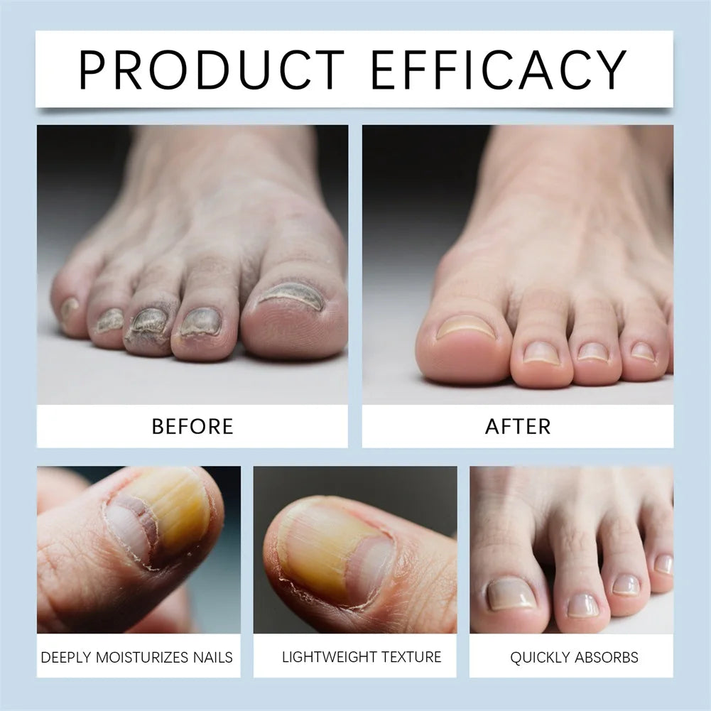 4pcs Nail-Fungus Pen Nail Growth Treatments Repair Serum Toenail-Fungus Treatments Extra Strength Nail Repair Serum