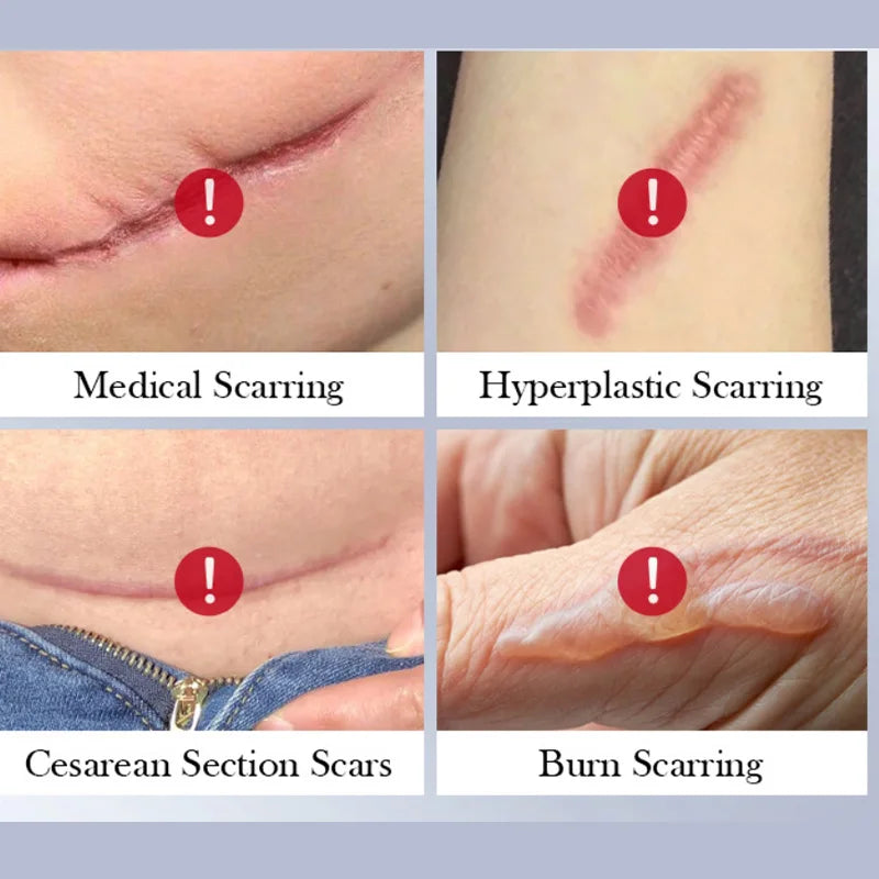 1/2/3PC Scar Repair Cream Fade-out Scald Scar Skin Wound Cream Moisturizing Rejuvenating Hydrating Repair Gel Skin Care Products