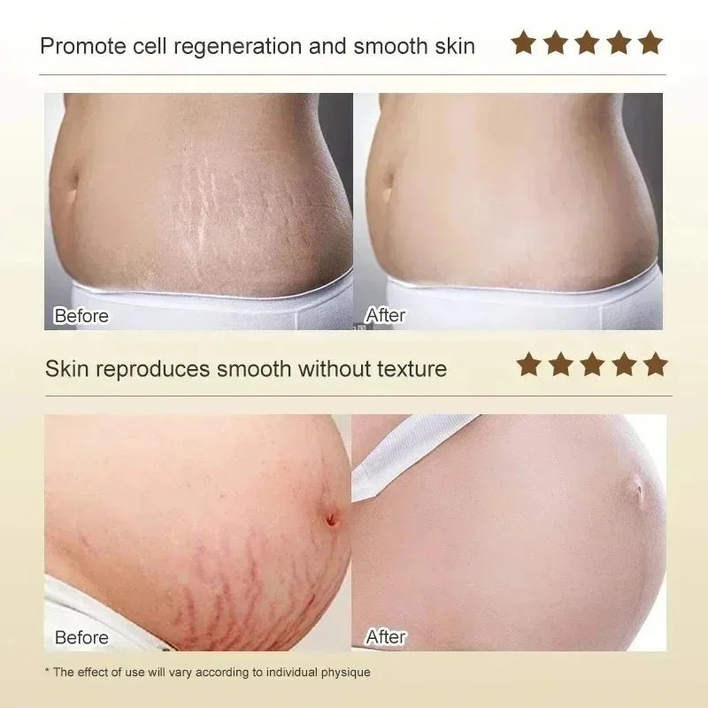 Cream For Pregnancy Stretch Marks Removal Eliminate Red White Old Stretch Marks 2025