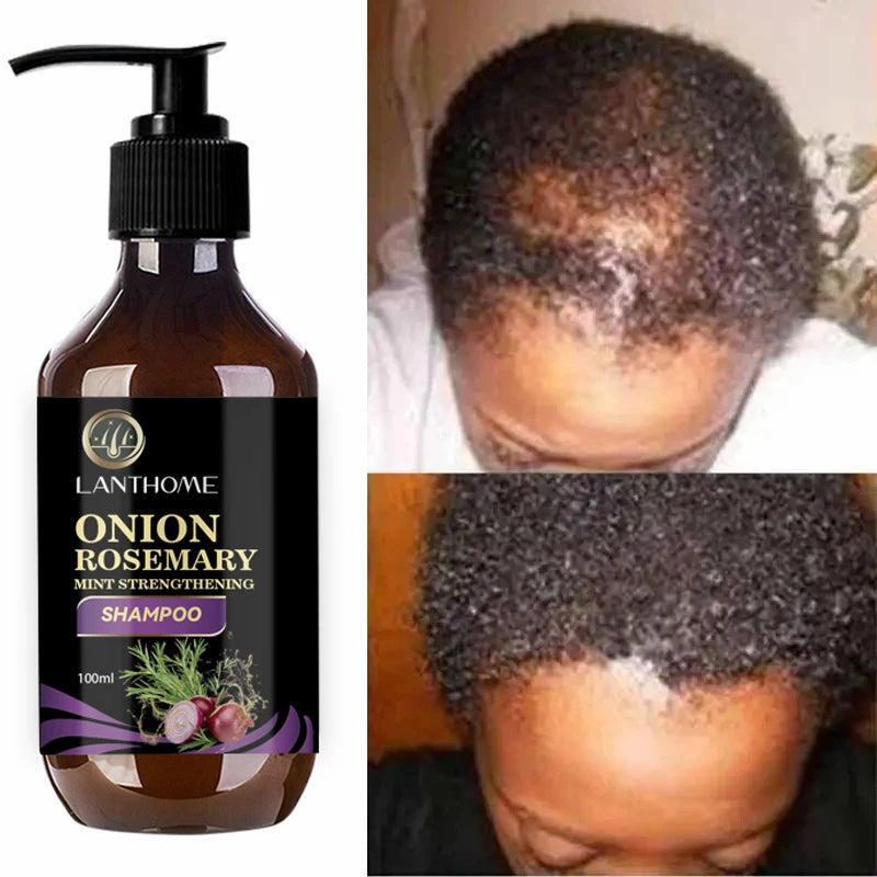 100ML Hair Shampoo For Fast Hair Growth Rosemary Onion Shampoo 30ML Spray Anti Hair Loss Effective Within 7 Day Hair Growth