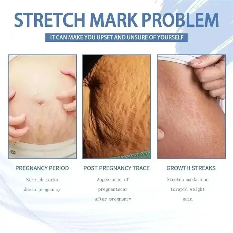 Cream For Pregnancy Stretch Marks Removal Eliminate Red White Old Stretch Marks 2025