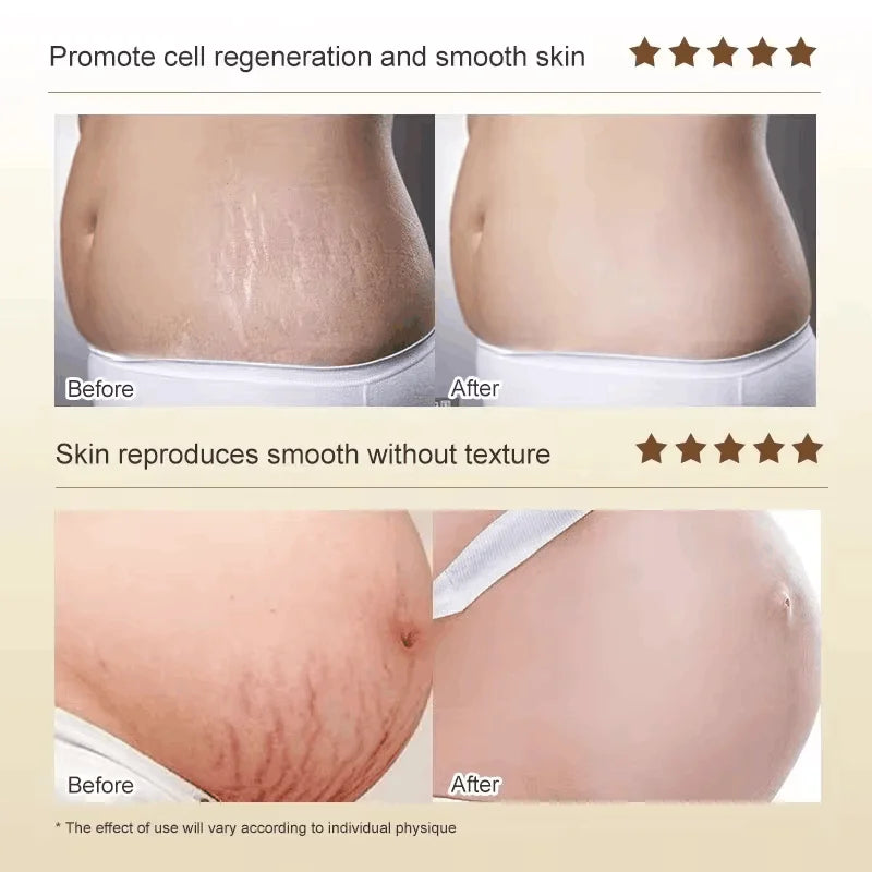 Stretch Marks Permanent Removal Cream Maternity Pregnant Women Pregnancy Anti-Winkle Smooth Repair Firming Skin Body Skin Care