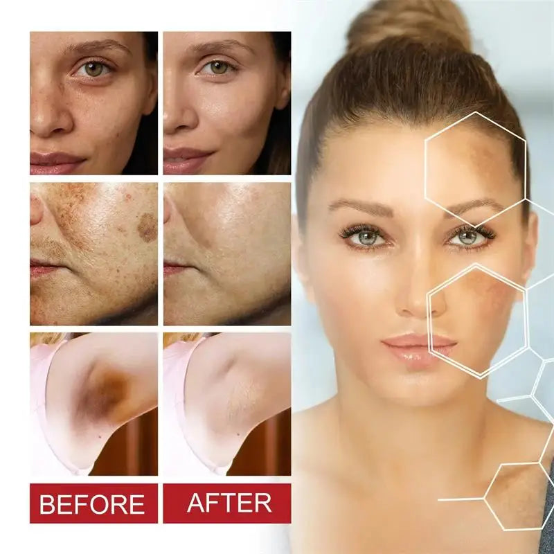 Powerful Spot-removing Whiten Cream Brighten Skin Fast Eliminates Melanin Pigmentation Melasma Dark Spots Moisturize Beauty Gel