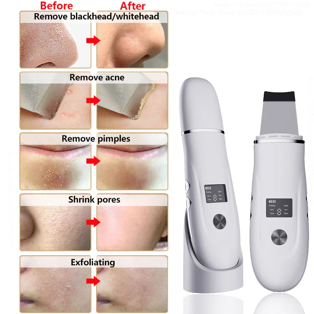 Blackhead Remover Electric Pore Face Cleaner Pimple Acne BlackHead Removal Black Dot Remove Ultrasonic Peeling Remover Blackhead