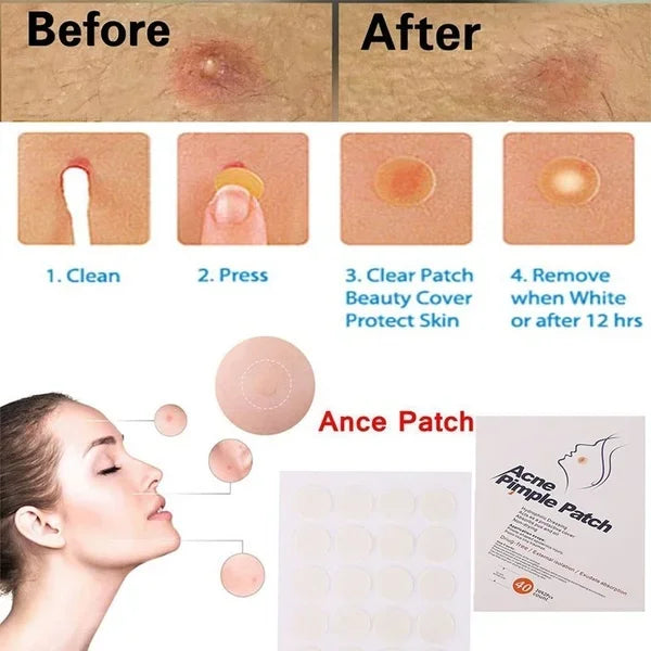 3 bag (1 bag 24pcs ) Face Acne Pimple Spot Scar Care Treatment Stickers Blackhead Removal Freckle Patches Acne Stickers