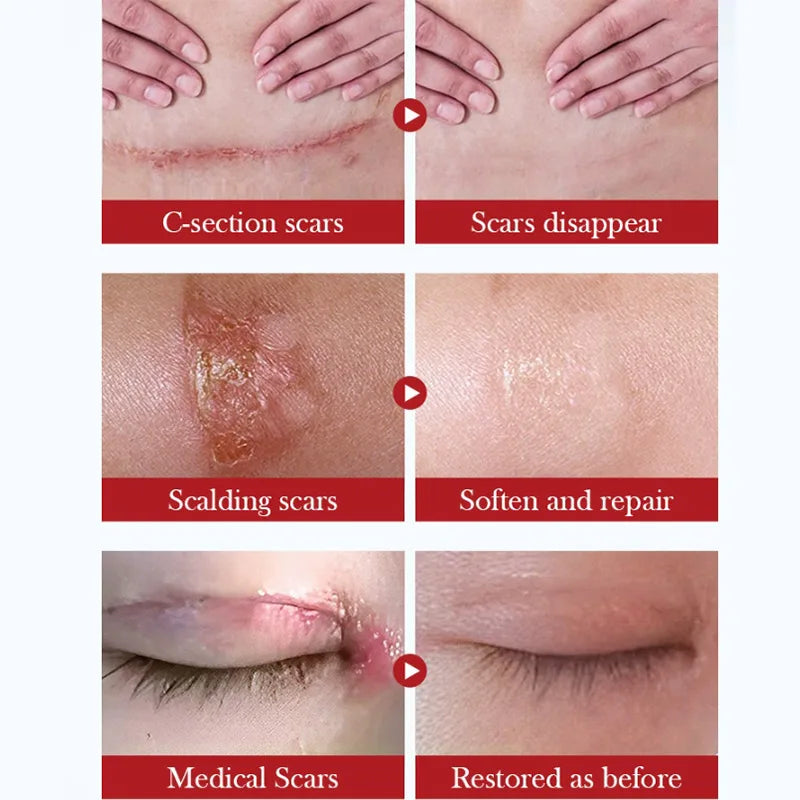 1/2/3PC Scar Repair Cream Fade-out Scald Scar Skin Wound Cream Moisturizing Rejuvenating Hydrating Repair Gel Skin Care Products