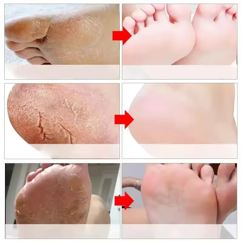 Herbal Anti Crack Foot Cream Spray Heel Cracking Repair Products Exfoliation Dead Skin Removal Softening Moisturize Smooth Care
