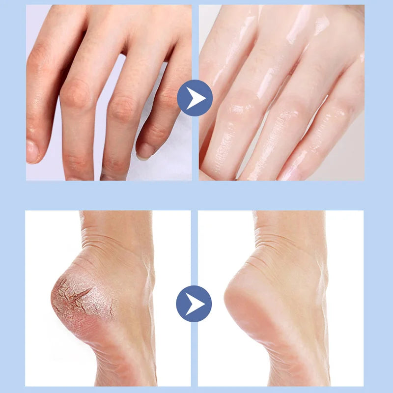 Dry and cracked heels, anti-crack cream, hand and foot hydration, moisturizing and moisturizing cream.