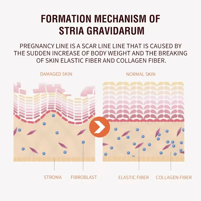 Stretch Marks Permanent Removal Cream Maternity Pregnant Women Pregnancy Anti-Winkle Smooth Repair Firming Skin Body Skin Care