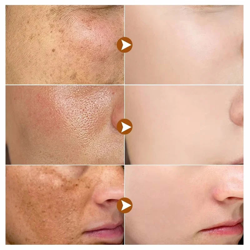 Dark Spots Remover Whitening Serum Face Freckle Melanin Correcting Reduce Fine Lines Brighten Essence Korean Beauty Skin Care