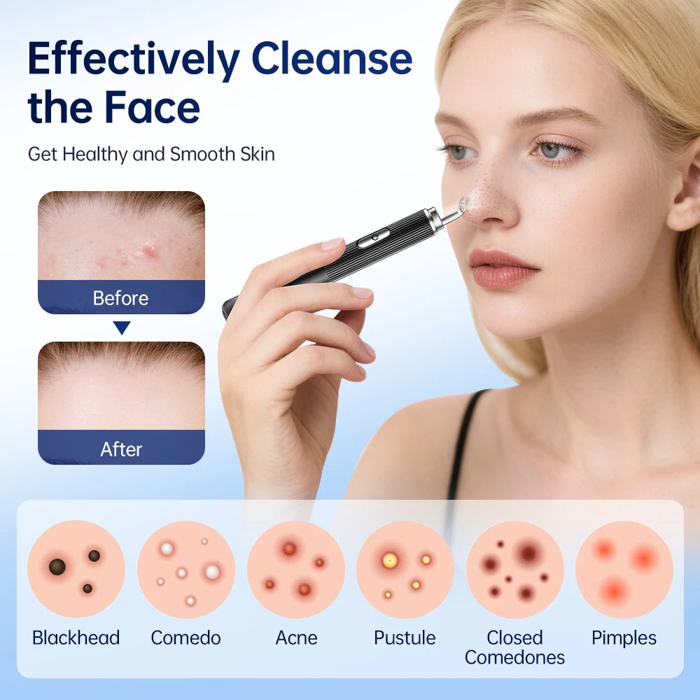 Visual Blackhead Remover 1296P HD Camera 50X Magnification Face Pimple Acne Pore Deep Clean Care Set Smart Blackhead Removal