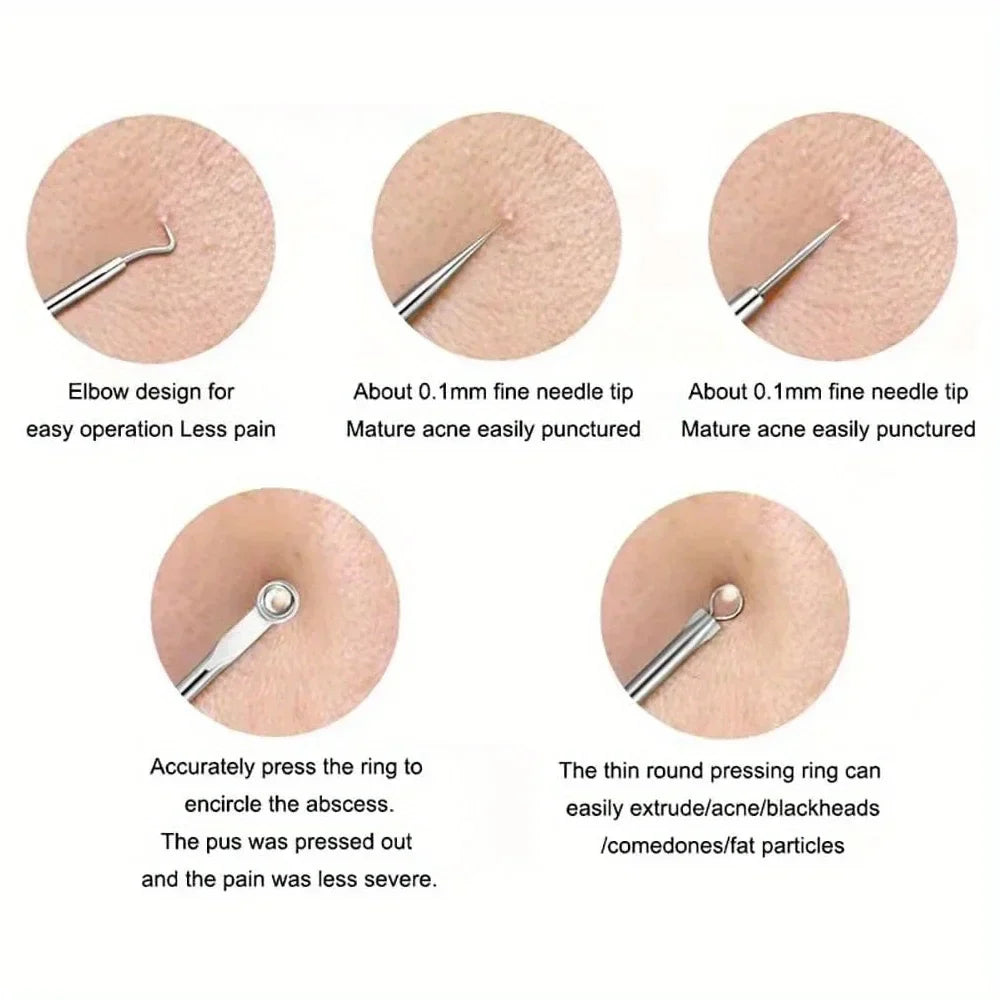 Blackhead Acne Pimple Blemish Extractor Remover Kit Stainless Steel Needles Remove Tools Face Skin Care Pore Cleaner 4pcs/bag
